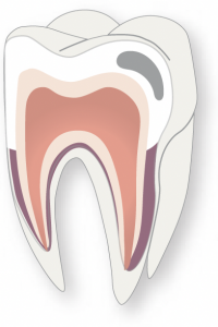 Initial-Stage-Cavity